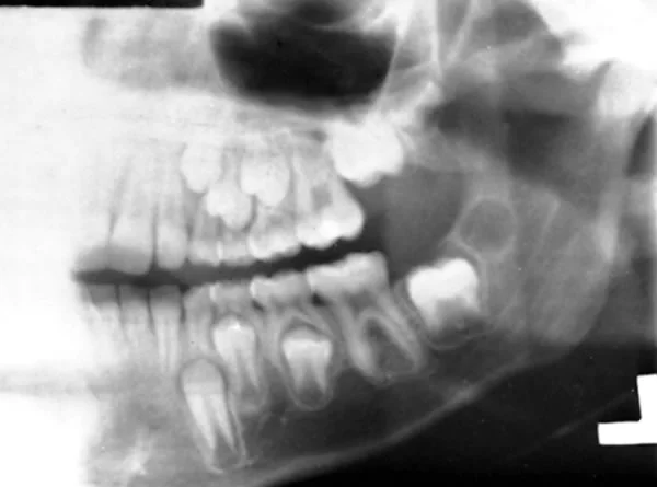 Panoramic radiograph showing erupting teeth: Pre-emergent eruption requires a path cleared by osteoclasts through the bone. Note the clearing of bone above the second mandibular molar as root formation begins.