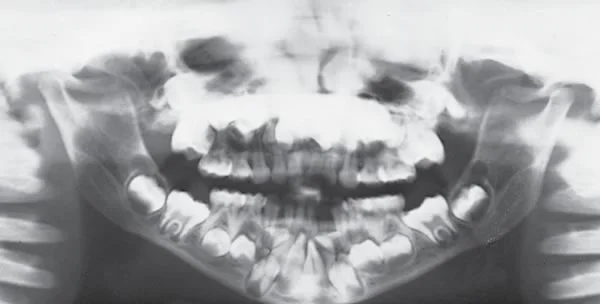 Panoramic radiograph of a patient with Cleidocranial Dysplasia: Note the impacted succedaneous teeth.
