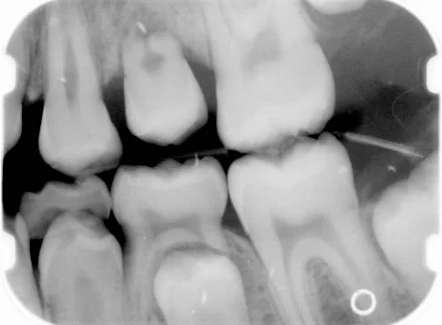 An erupting second premolar: Note that the tooth is erupting despite the lack of root formation.