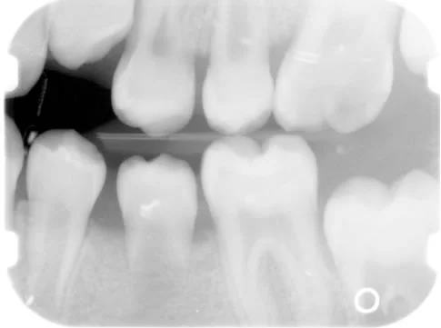 Erupting second premolar: An abscess of the overlying primary molar sped the eruption of this premolar by clearing bone in the eruption path.
