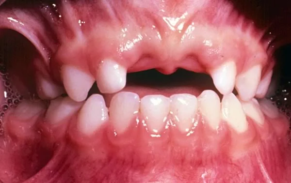 Image 1: A 3-year old boy soon after he knocked out both his maxillary primary central incisors in an accident.