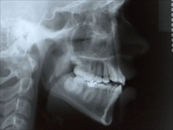 Cephalometric film showing developing third molars: Third molars in the crown stage do not erupt and can be used as stable structures for superimposition.