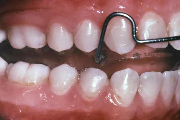 Functional appliance as retainer: For Class II patients who are growing unfavorably after completion of treatment during adolescence, an activator- or bionator-type functional appliance is the best retainer. It is made to fit the patient’s post-treatment occlusion if no change has occurred, or with slight mandibular advancement if some change has already occurred. Night-time wear until growth ceases is enough.