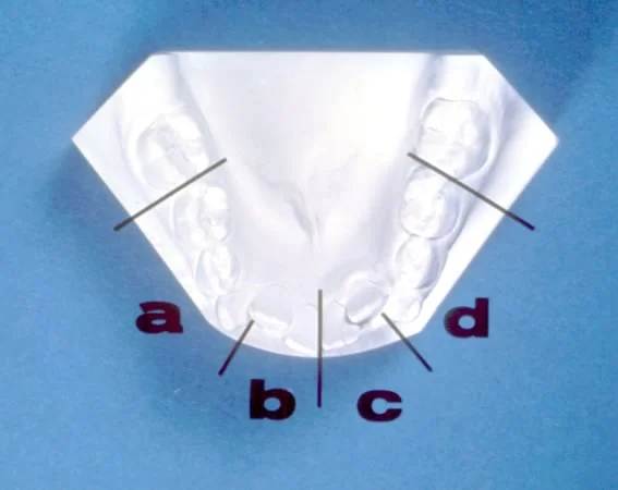 Measuring the amount of space available for the unerupted permanent teeth.