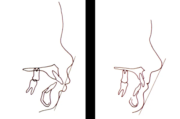 Protrusive lips and incisors on left; retrusive on right