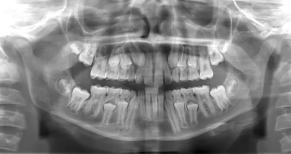 In this panoramic radiograph, note that the teeth on the patient's right look larger than those on the left--which would make measurements of tooth size inaccurate.