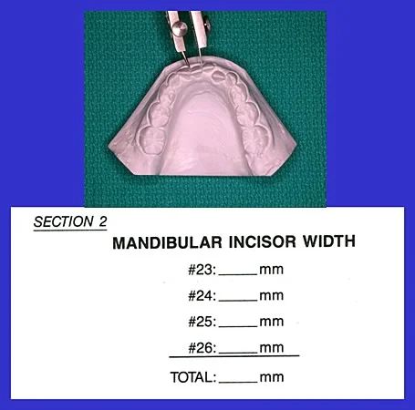 Image 1, Measurement of mandibular incisors: Width of the mandibular incisors measured with dividers and recorded in the MDA form.