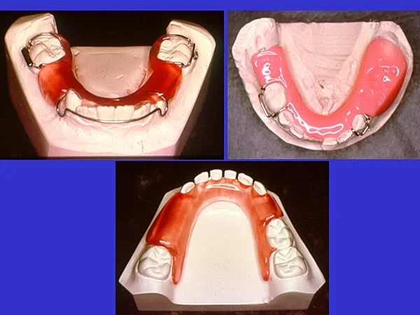 Removable space maintainers: Removable space maintainers used when multiple teeeth are extracted.