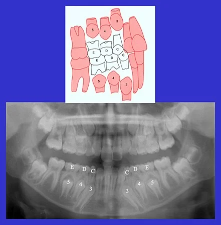 Image 1, Leeway Space in the mixed dentition: Leeway space in the buccal segments of the primary and the permanent dentition.