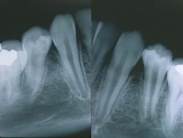 Image 1, Residual effects of serial extraction: Drifting and tipping of permanent teeth after serial extraction.