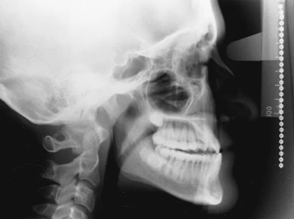 Lateral cephalometric radiograph of an individual with disproportionate growth of the upper and lower jaws. Serial cephs to monitor growth are an important tool in clinical treatment of problems of this type.