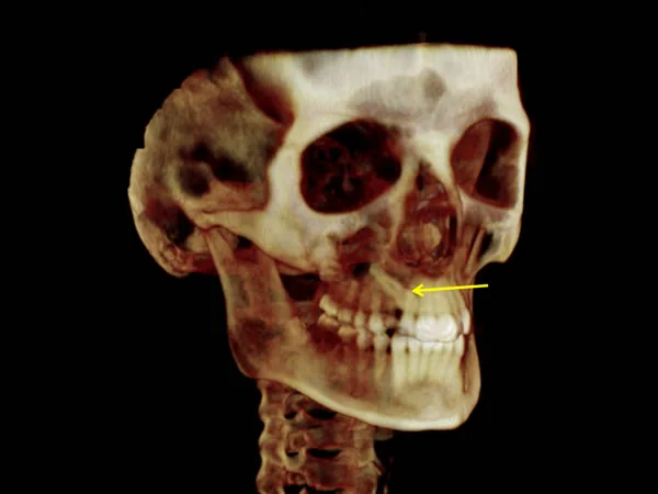 3D CBCT Volume: 3D images like this one are valuable because hard tissue can be evaluated from multiple perspectives. Note the impacted maxillary canine (yellow arrow).