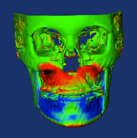 Cone Beam CT Superimposition: Changes created by surgery to advance the maxilla and set back the mandible in this patient. The colors reveal the amount of change and its direction. Red shows anterior or outward movement, green shows areas of little or no change, and blue shows areas of posterior or inward movement. The intensity of the red and blue indicates the magnitude of the change.