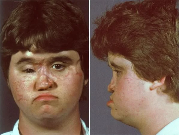 A boy with an injury to the soft tissue of the midface: As a result of impeded soft tissue growth, the maxilla has not grown down and forward.