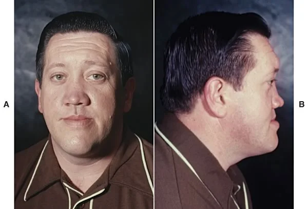 A man who lost his nasal cartilage at age 7: Whether his midface deficiency is due to the trauma, surgery, or loss of cartilage is unclear, but his condition is still suggestive of some important role for nasal cartilage in growth.