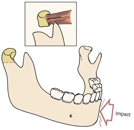 Illustration of trauma to the mandible and resulting effects on the contralateral condyle: Trauma to the mandible often results in a condylar neck facture and resorption of the condyle and its cartilage.