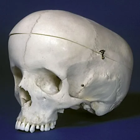 Skull of a person with hydrocephaly: As intra-cranial pressure builds, the cranial vault reacts by growing larger.