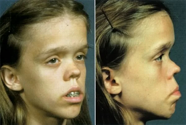 A girl with achondroplasia: Her midface deficiency is the result of inadequate growth at the synchondroses of the cranial base.