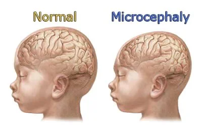 The cranial vault and brain within: When the brain fails to grow, so does the cranial vault, and microcephaly results.
