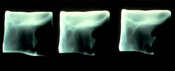 Radiographic view of fractured condyle: The condyle remained in the joint area and inhibited movement.