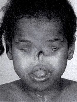 A boy with cebocephaly: Note the sever midface deficiency.
