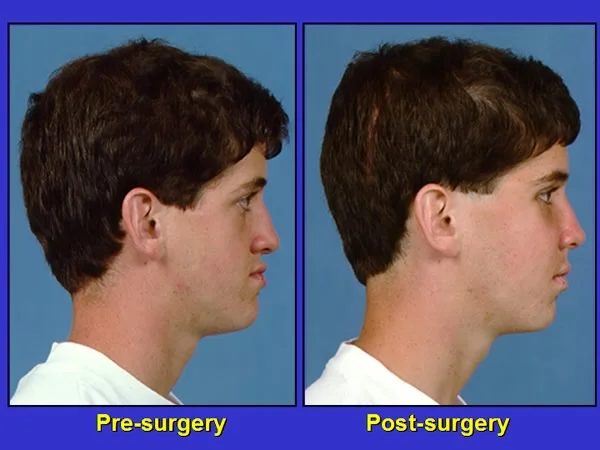 Surgical treatment of a skeletal anterior cross bite.: Le Fort I maxillary advancement for correction of Class III skeletal malocclusion and a skeletal anterior crossbite.