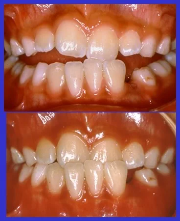 Pseudo-Class III Malocclusion: Patient with a pseudo-Class III malocclusion due to a CR-MI shift of the mandible.