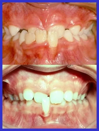 Loss of periodontal attachment due to anterior crossbite: Significant loss of periodontal attachment and gingival stripping can occur in lower incisors that are positioned labially due to an anterior crossbite.