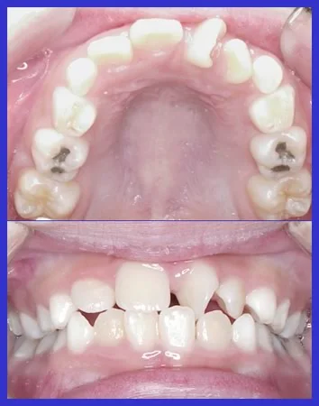 Anterior crossbite with rotated maxillary central incisor: Anterior crossbite due to rotated maxillary central incisor; maxillary primary canines will have to be extracted to create space for the crossbite correction.