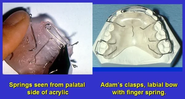 Removable appliance: Removable appliance with a finger spring to tip the maxillary incisors facially.