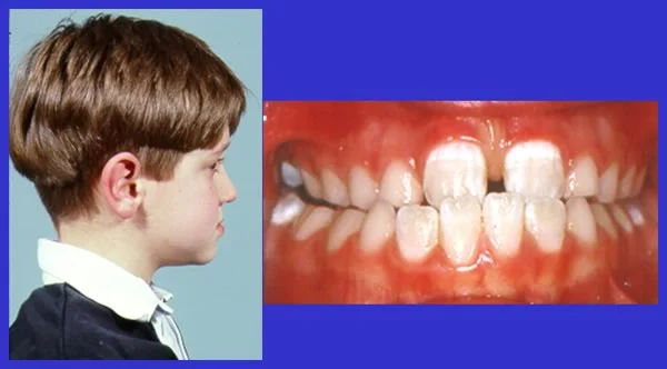 Combined anterior and posterior crossbite: This patient presents with an anterior and posterior crossbite, which is highly suggestive of an underlying Class III skeletal malocclusion.
