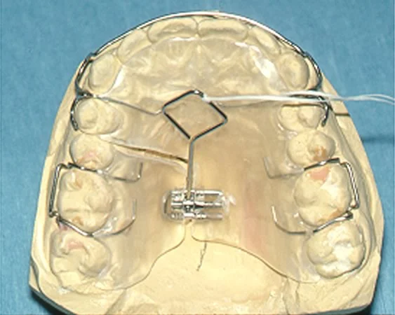 Removable Split Plate Appliances: Removable appliances that utilize an expansion screw or wire spring can be used to correct a posterior crossbite.