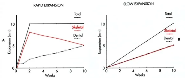 Graphic comparison of rapid versus slow expansion: The same amount of total, skeletal, and dental expansion may occur during rapid and slow expansion.