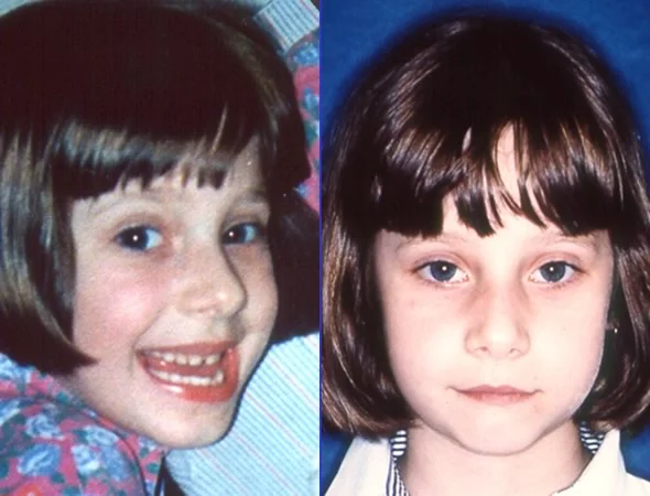 Rapid palatal expansion in a very young child: Rapid palatal expansion in this 4-year-old girl resulted in obvious changes in the width of her nasal bridge.