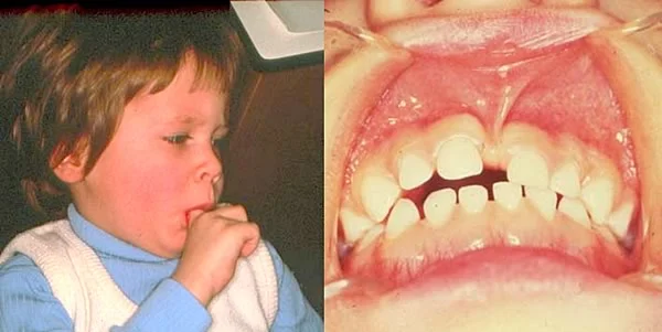Oral finger habit results: Young boy with a habit of sucking his right index finger and the dental results of the habit.