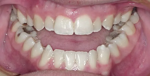Skeletal open bite: A severe anterior open bite in an adolescent almost always has a skeletal component.