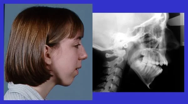 Severe skeletal open bite: This girl has a severe open bite, due largely to downward-backward rotation of the mandible during growth. She is a candidate for orthognathic surgery.