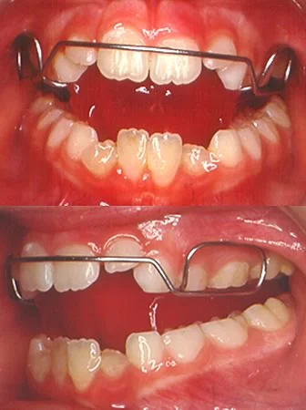 Appliance with posterior bite blocks: The bite blocks in this appliance inhibit the eruption of the posterior teeth while allowing the anterior teeth to erupt further, which helps in the correction of an anterior open bite.