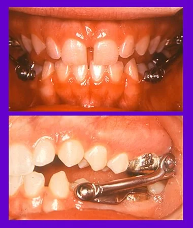 Herbst, front view: Herbst appliance for Class II growth modification.