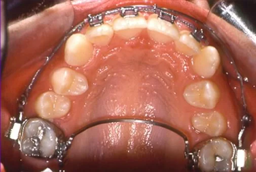 Permanent canines and premolars are erupting out of ideal alignment, following early expansion.