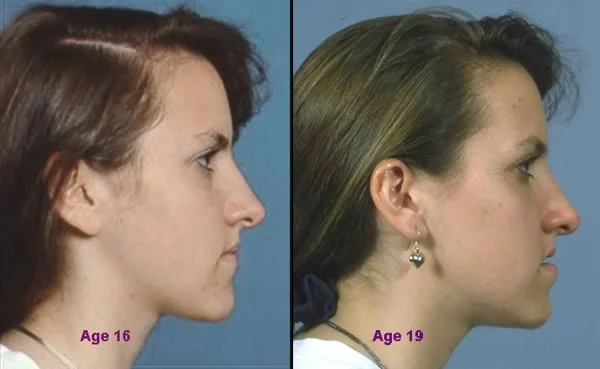 Age 16 to 19, increased Class III severity due to continued growth.