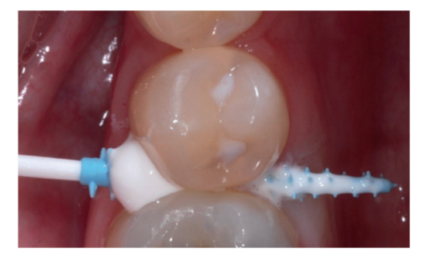 Figure 3. Clinical application of CPP-ACP paste using an appropriately sized interdental applicator (courtesy of Louis Mackenzie)