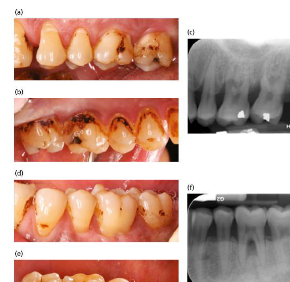 Fig. 11-9 Same patient as in Fig. 11-8. (a, b) Maxillary left buccal and palatal views and (c) corresponding radiograph; (d, e) mandibular left buccal and lingual views and (f) corresponding radiograph. Heavy staining and advanced bone loss are apparent. (Source: Courtesy of Dr. Matthew Hickin.)