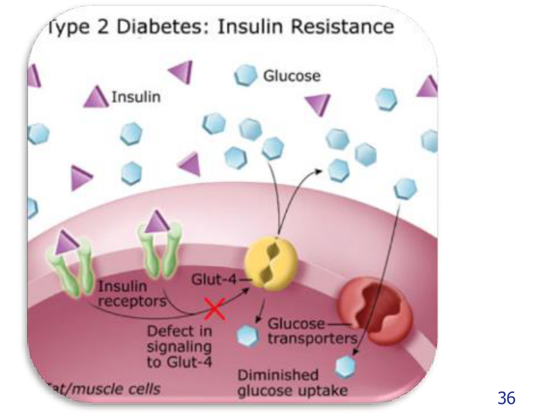 Type 2 Diabetes: Insulin Resistance