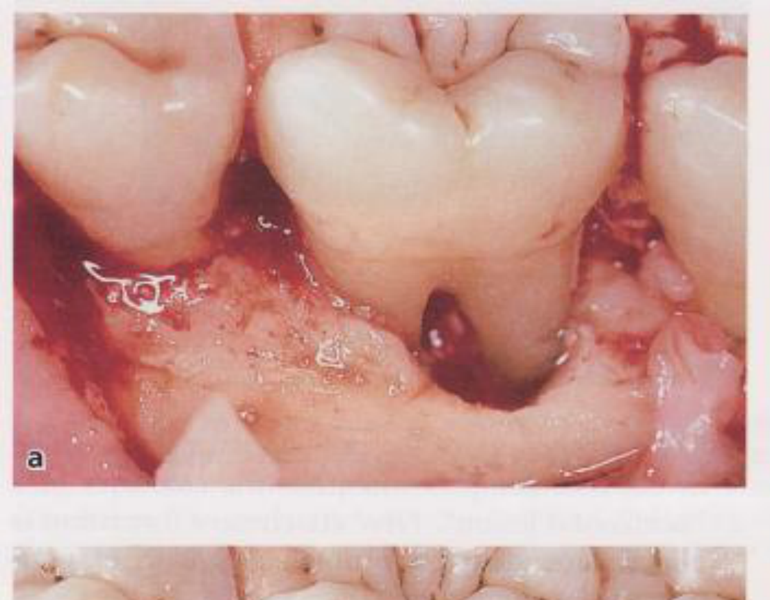 Fig. 39-43 Aspect of a lingual degree II furcation involvement in a mandibular first molar. (a) Note the infrabony component of the defect and the level of the approximal supporting bone in relation to the furcation fornix. (b) The Teflon membrane sutured in position and supported by the interproximal alveolar bone. (c) The flap positioned and sutured over the membrane. (d) At re-entry, after 6 months of healing, the previously exposed furcation defect was closed and filled with bone tissue.