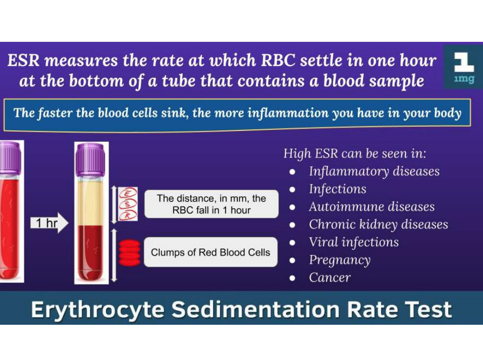 Erythrocyte Sedimentation Rate Test