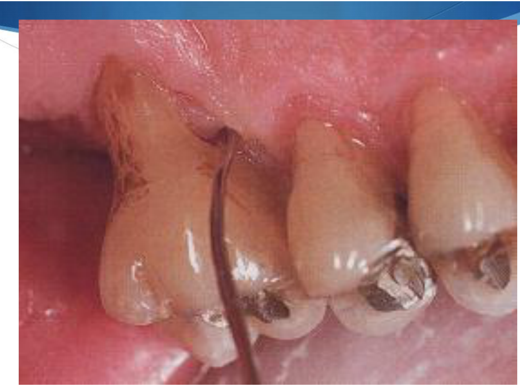 Clinical exam: Nabers Probe