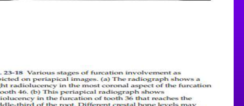 Fig. 23-18 Various stages of furcation involvement as depicted on periapical images. (a) The radiograph shows a slight radiolucency in the most coronal aspect of the furcation of tooth 46. (b) This periapical radiograph shows radiolucency in the furcation of tooth 36 that reaches the middle-third of the root. Different crestal bone levels may mimic no radiolucency in the furcation of tooth 37. (c) This radiograph exhibits a radiolucency of the furcation of tooth 26 that extends up to the apex of the respective roots.
