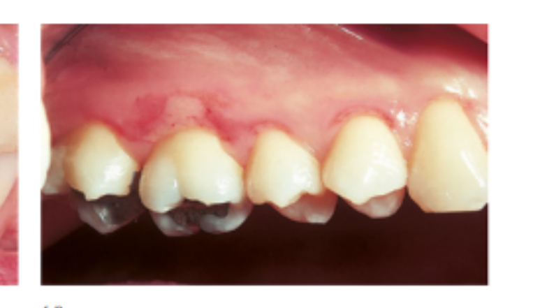 (b) Note the multiple ulcerations of the buccal gingival margin in the right maxilla.