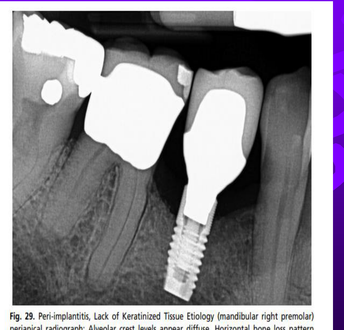 Fig. 29. Peri-implantitis, Lack of Keratinized Tissue Etiology (mandibular right premolar) periapical radiograph: Alveolar crest levels appear diffuse. Horizontal bone loss pattern noted. Image provided by authors.
